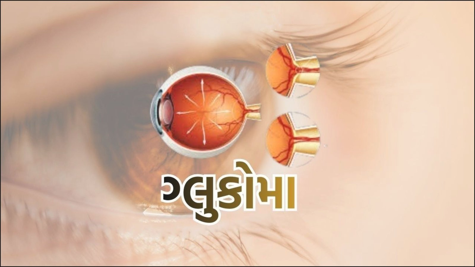ગ્લુકોમા | Glaucoma | GUJARATI NEWS BULETIN